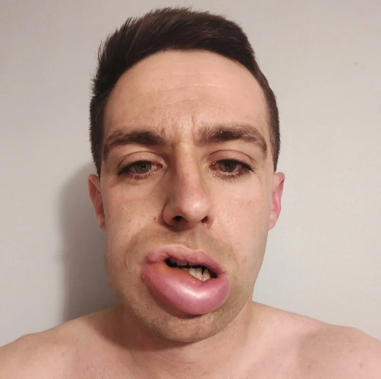 Cambridge trial offers Jack hope after treatments fail